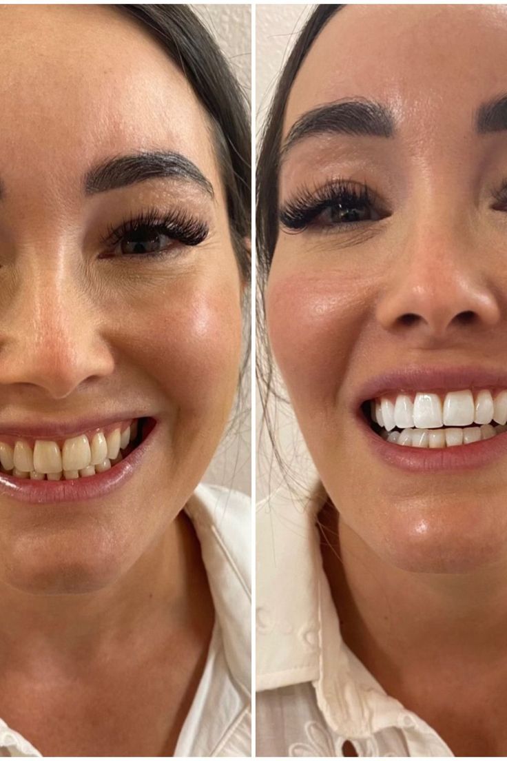 Side-by-side smile photographs before and after miswak use.